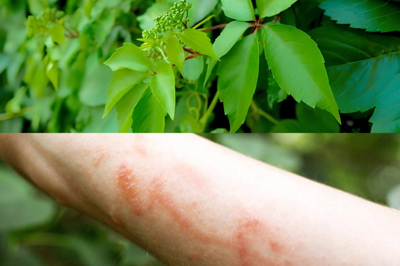 How to Recognize, Treat, and Prevent Po1son Ivy Rash Before It Ruins Your Summer